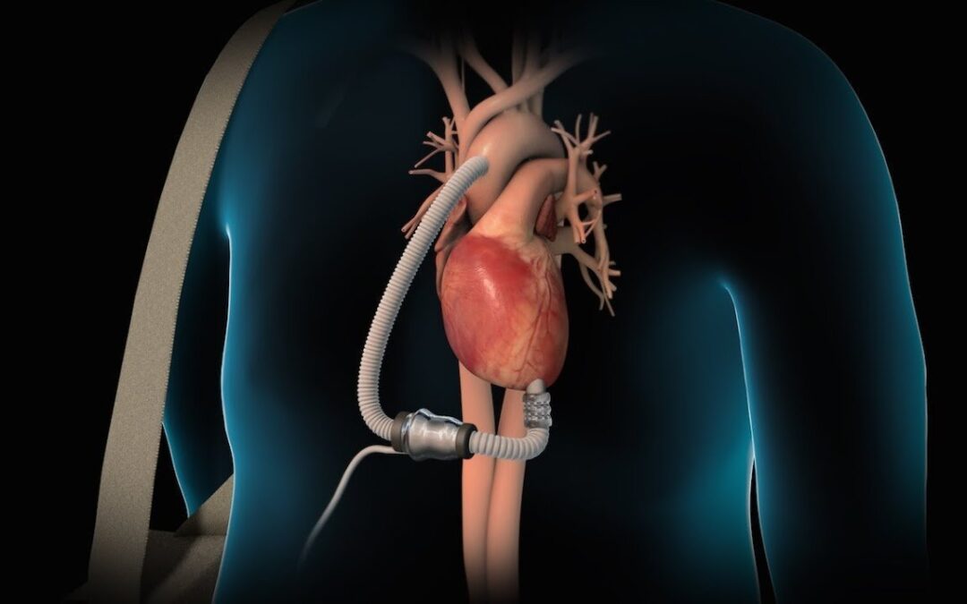 LVAD, Nutrition And Blood Thinners